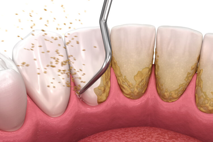 scaling-and-root-planing-post-op-instructions-abq-dental-associates